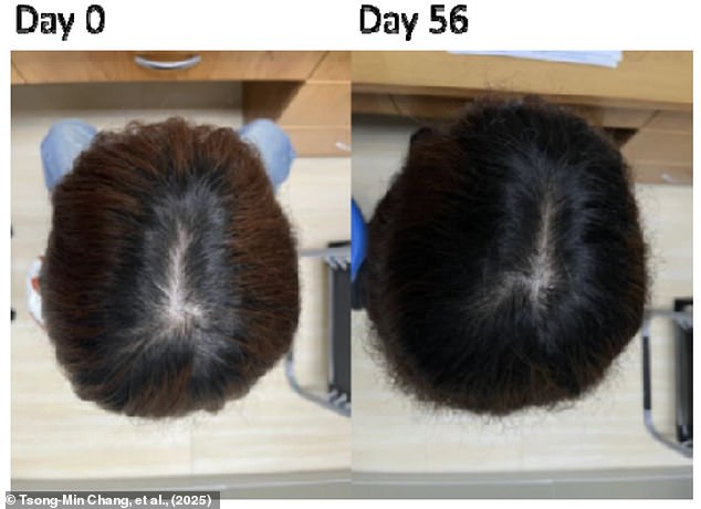 Potential Plant-Based Hair Loss Treatment Shows Promise in Two Months, Developed by Taiwanese Researchers
