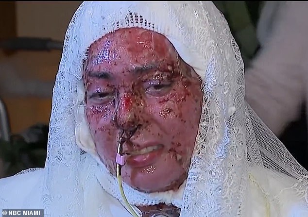 Freak Grill Accident Leaves Woman with Severe Burns, Prompting Unexpected Reflection on Fiancé