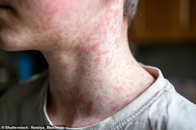 Measures Surge: US on Brink of measles-free Status Loss