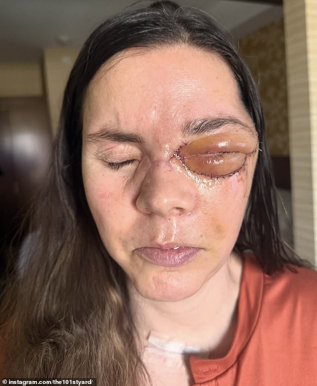 Kenai Mother Survives Bear Attack With Severe Spine And Hip Damage