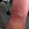 Man's 'Unbearable' Spider Bite Sparks Concern Over Public Health Regulations