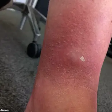 Man's 'Unbearable' Spider Bite Sparks Concern Over Public Health Regulations