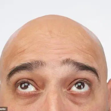 Japanese Researchers Edge Closer to Hair Loss Solution, but Challenges Remain