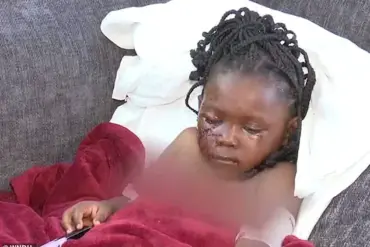 BREAKING: Five-Year-Old Girl in Indiana Survives Brutal Pit Bull Attack, Left Permanently Scarred