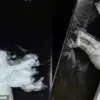 Shocking X-Rays Reveal Life-Changing Firework Injuries: A Fourth of July Reminder of Hidden Dangers
