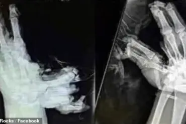 Shocking X-Rays Reveal Life-Changing Firework Injuries: A Fourth of July Reminder of Hidden Dangers