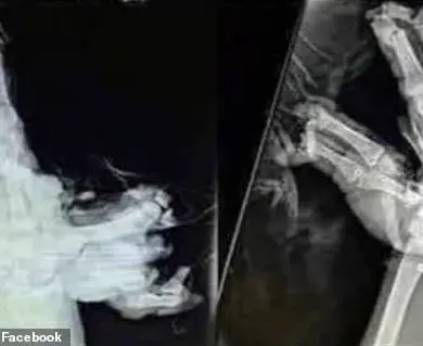 Shocking X-Rays Reveal Life-Changing Firework Injuries: A Fourth of July Reminder of Hidden Dangers