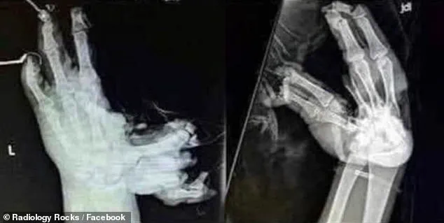 Shocking X-Rays Reveal Life-Changing Firework Injuries: A Fourth of July Reminder of Hidden Dangers