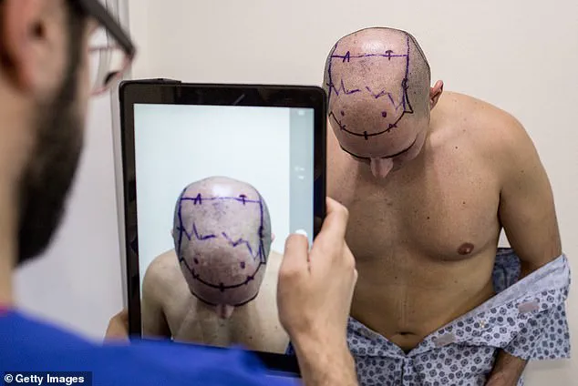 Surgeon Issues Stark Warning: Overseas Hair Transplants Can Lead to Severe Consequences