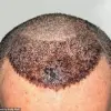 Surgeon Issues Stark Warning: Overseas Hair Transplants Can Lead to Severe Consequences