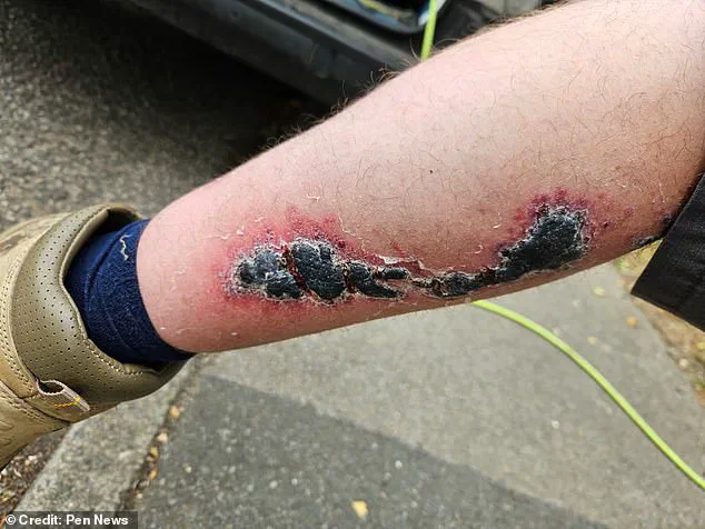 A Medical Anomaly and the Hidden Peril of Britain’s Most Dangerous Spider